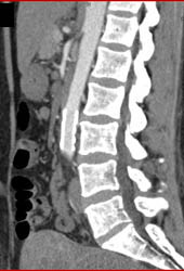 Stent to Repair Near Aortic Occlusion- See Prior Case - CTisus CT Scan