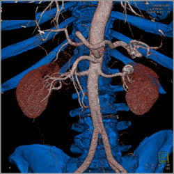 Renal Artery Aneurysm - CTisus CT Scan