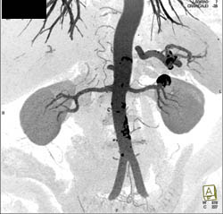 Renal Artery Aneurysm - CTisus CT Scan