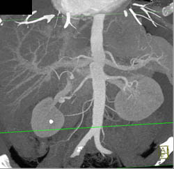 Depending on the MIP Projection Right Kidney Has 1 to 3 Right Renal Arteries. This Shows An Issue With MIP Rendering - CTisus CT Scan