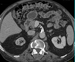 Stenosis SMA Due to Plaque - CTisus CT Scan