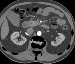 Automatic Bone Editing- See How Close It Comes to the Aorta - CTisus CT Scan