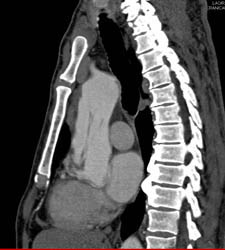 Type A Dissection - CTisus CT Scan