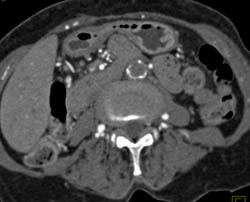 Occlusion of Infrarenal Aorta With Collateral Flow - CTisus CT Scan