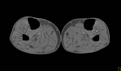 Bone Editing for CT Angiogram- Runoff Study - CTisus CT Scan