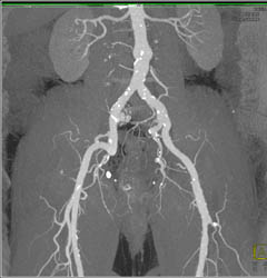 Runoff With Automatic Bone Removal - CTisus CT Scan