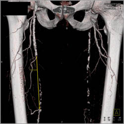 Diseased SFA Bilaterally - CTisus CT Scan