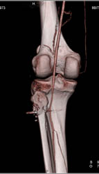 GSW to Knee Without Vascular Injury - CTisus CT Scan