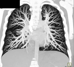 Left Upper Lobe Pulmonary Arteriovenous Malformation (PAVM) - CTisus CT Scan