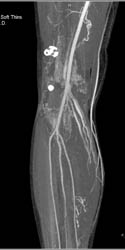 CTA Leg With Normal Trifurcation - CTisus CT Scan