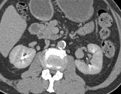 Left Renal Artery Aneurysm That Is Easy to Miss - CTisus CT Scan