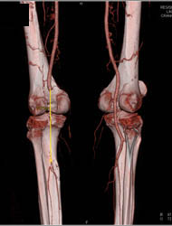 Occluded Left Popliteal Artery Due to Trauma - CTisus CT Scan