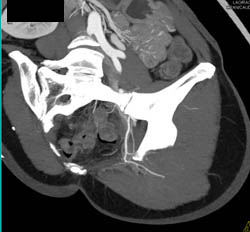 Gluteal Perforators Mapping - CTisus CT Scan