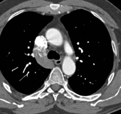 Interrupted Inferior Vena Cava (IVC) - CTisus CT Scan