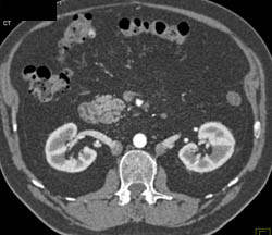 Duplicated Inferior Vena Cava (IVC) - CTisus CT Scan