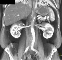 Duplicated Inferior Vena Cava (IVC) - CTisus CT Scan