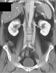 Duplicated Inferior Vena Cava (IVC) - CTisus CT Scan