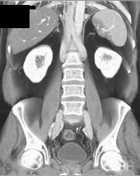 Duplicated Inferior Vena Cava (IVC) - CTisus CT Scan