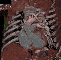 Ectatic Arch Vessels - CTisus CT Scan