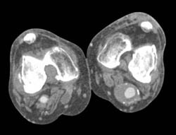 Popliteal Artery Aneurysm - CTisus CT Scan