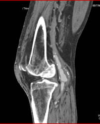 Popliteal Artery Aneurysm - CTisus CT Scan