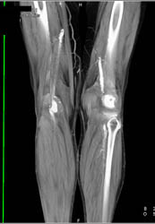 Popliteal Artery Aneurysm - CTisus CT Scan