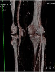 Popliteal Artery Aneurysm - CTisus CT Scan