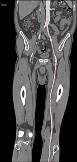 Vessel Tracking of Diseased SFA - CTisus CT Scan