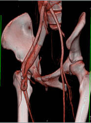 Av Fistulae - CTisus CT Scan