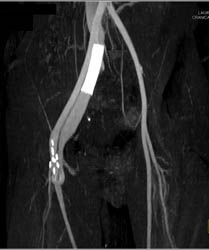 Av Fistulae - CTisus CT Scan