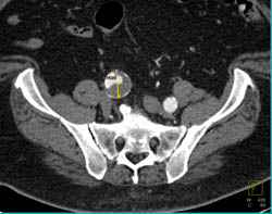 Iliac Artery Aneruysm - CTisus CT Scan