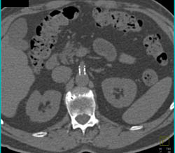 Patent Stent in SMA and Celiac - CTisus CT Scan