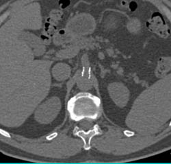 Patent Celiac Stent - CTisus CT Scan