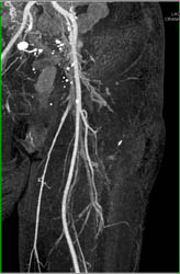 Normal CTA - CTisus CT Scan