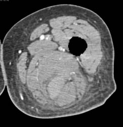 Thigh Hematoma With Bone Edits - CTisus CT Scan