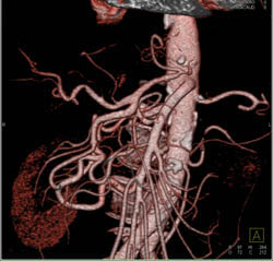 Celiac Stenosis With Collaterals Through Gastroduodenal Artery (GDA) - CTisus CT Scan