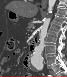 Diseased SMA and Celiac Artery and Abdominal Aortic Aneurysm (AAA) - CTisus CT Scan