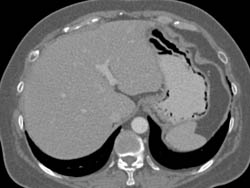 Gastric Emphysema and Portal Vein (PV) Air - CTisus CT Scan