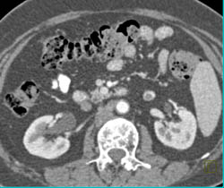 Clot in Left Gonadal Vein - CTisus CT Scan