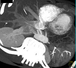 MIP of Mesenteric Vessels - CTisus CT Scan