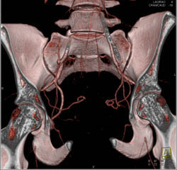 Branching Vessels of Internal Iliac Arteries - CTisus CT Scan