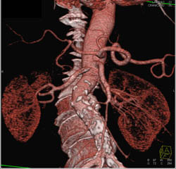 Diseased Abdominal Aorta - CTisus CT Scan