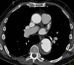 Ulceration and Intramural Hematoma - CTisus CT Scan