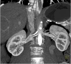 Multiple Renal Artery Aneruysms on Right and Prehilar Branching on Left in Potential Donor - CTisus CT Scan