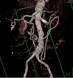 Occluded Celiac Artery With Collaterals Through the IMA - CTisus CT Scan