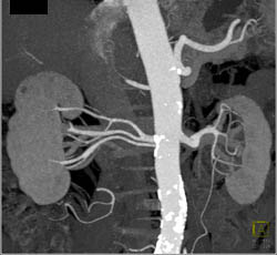 2 Right Renal Arteries Plus Pre-hilar Branching - CTisus CT Scan