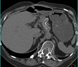 Partially Occluded Celiac Artery Stent - CTisus CT Scan