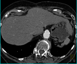 Celiac Stent With Distal Occlusion- See Full Image Sequence - CTisus CT Scan