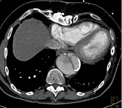 Type A Dissection - CTisus CT Scan