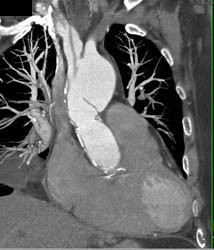 Type A Dissection - CTisus CT Scan